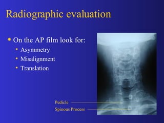 [object Object],[object Object],[object Object],[object Object],Radiographic evaluation Pedicle Spinous Process 