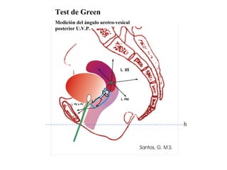 Test de Green
Medición del ángulo uretro-vesical
posterior U.V.P.




                                     h
 