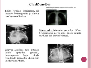 Leve: Retículo esmeridalo, no
intenso, broncograma y silueta
cardiaca con limites.
Moderado: Moteado granular difuso
broncograma aéreo más nítido silueta
cardiaca con bordes borroso.
Grave: Moteado fino intenso
dando opacidad general,
broncograma bien nítido
resultando imposible distinguir
la silueta cardiaca.
Clasificación:
 