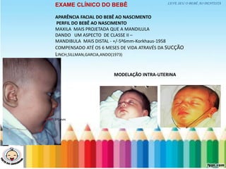 LEVE SEU O BEBÊ AO DENTISTA
EXAME CLÍNICO DO BEBÊ
APARÊNCIA FACIAL DO BEBÊ AO NASCIMENTO
PERFIL DO BEBÊ AO NASCIMENTO
MAXILA MAIS PROJETADA QUE A MANDILULA
DANDO UM ASPECTO DE CLASSE II –
MANDIBULA MAIS DISTAL - +/-5ª6mm-Korkhaus-1958
COMPENSADO ATÉ OS 6 MESES DE VIDA ATRAVÉS DA SUCÇÃO
LINCH,SILLMAN,GARCIA,ANDO(1973)
3ª5mm
MODELAÇÃO INTRA-UTERINA
 