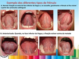 LEVE SEU O BEBÊ AO DENTISTA
A. Normal: Fixação no meio da face inferior da língua e, no assoalho, geralmente o frênulo só fica visível
a partir das carúnculas sublinguais
B. Anteriorizado: Quando, na face inferior da língua, a fixação estiver acima da metade
Exemplo dos diferentes tipos de frênulo
 
