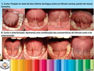 LEVE SEU O BEBÊ AO DENTISTA
C. Curto: Fixação no meio da face inferior da língua como no frênulo normal, porém de menor
tamanho.
D. Curto e anteriorizado: Apresenta uma combinação das características do frênulo curto e do
anteriorizado
 