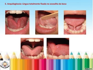 LEVE SEU O BEBÊ AO DENTISTA
E. Anquiloglossia: Língua totalmente fixada no assoalho da boca
 