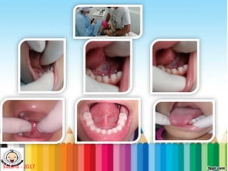 LEVE SEU O BEBÊ AO DENTISTA
Suzana - 2017
 