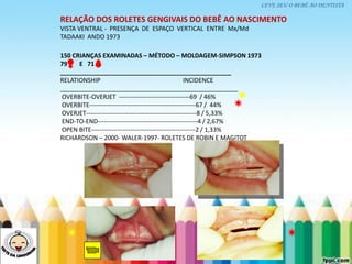 LEVE SEU O BEBÊ AO DENTISTA
RELAÇÃO DOS ROLETES GENGIVAIS DO BEBÊ AO NASCIMENTO
VISTA VENTRAL - PRESENÇA DE ESPAÇO VERTICAL ENTRE Mx/Md
TADAAKI ANDO 1973
150 CRIANÇAS EXAMINADAS – MÉTODO – MOLDAGEM-SIMPSON 1973
79 E 71
__________________________________________________
RELATIONSHIP INCIDENCE
____________________________________________________
OVERBITE-OVERJET ----------------------------------69 / 46%
OVERBITE---------------------------------------------------67 / 44%
OVERJET-----------------------------------------------------8 / 5,33%
END-TO-END------------------------------------------------4 / 2,67%
OPEN BITE--------------------------------------------------2 / 1,33%
RICHARDSON – 2000- WALER-1997- ROLETES DE ROBIN E MAGITOT
 