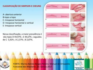 LEVE SEU O BEBÊ AO DENTISTA
FONTE: Marina Batista Borges Pereira. Manual de Ortopedia
Funcional dos Maxilares .Ed. Santos.2017
CLASSIFICAÇÃO DE SIMPSON E CHEUNG
A- abertura anterior
B-topo a topo
C- trespasse horizontal
D- trespasse horizontal e vertical
E- trespasse vertical
Nessa classificação, a maior prevalência é
dos tipos D 44,97% ; E 44,67% ; seguidos
de C 5,92% ; A 2,37% ; B 2,07%.
 