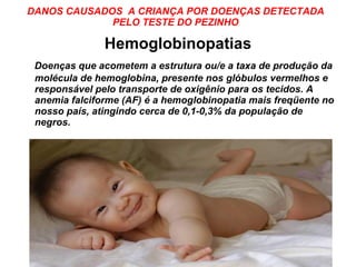 DANOS CAUSADOS  A CRIANÇA POR DOENÇAS DETECTADA PELO TESTE DO PEZINHO Hemoglobinopatias Doenças que acometem a estrutura ou/e a taxa de produção da molécula de hemoglobina, presente nos glóbulos vermelhos e responsável pelo transporte de oxigênio para os tecidos. A anemia falciforme (AF) é a hemoglobinopatia mais freqüente no nosso país, atingindo cerca de 0,1-0,3% da população de negros. 