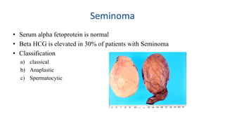 Seminoma 
• Serum alpha fetoprotein is normal 
• Beta HCG is elevated in 30% of patients with Seminoma 
• Classification 
a) classical 
b) Anaplastic 
c) Spermatocytic 
 