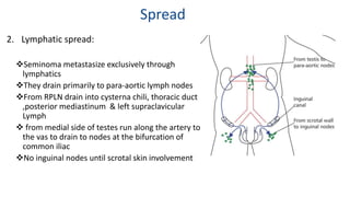 Spread 
2. Lymphatic spread: 
Seminoma metastasize exclusively through 
lymphatics 
They drain primarily to para-aortic lymph nodes 
From RPLN drain into cysterna chili, thoracic duct 
,posterior mediastinum & left supraclavicular 
Lymph 
 from medial side of testes run along the artery to 
the vas to drain to nodes at the bifurcation of 
common iliac 
No inguinal nodes until scrotal skin involvement 
 