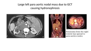 Large left para aortic nodal mass due to GCT 
causing hydronephrosis 
 