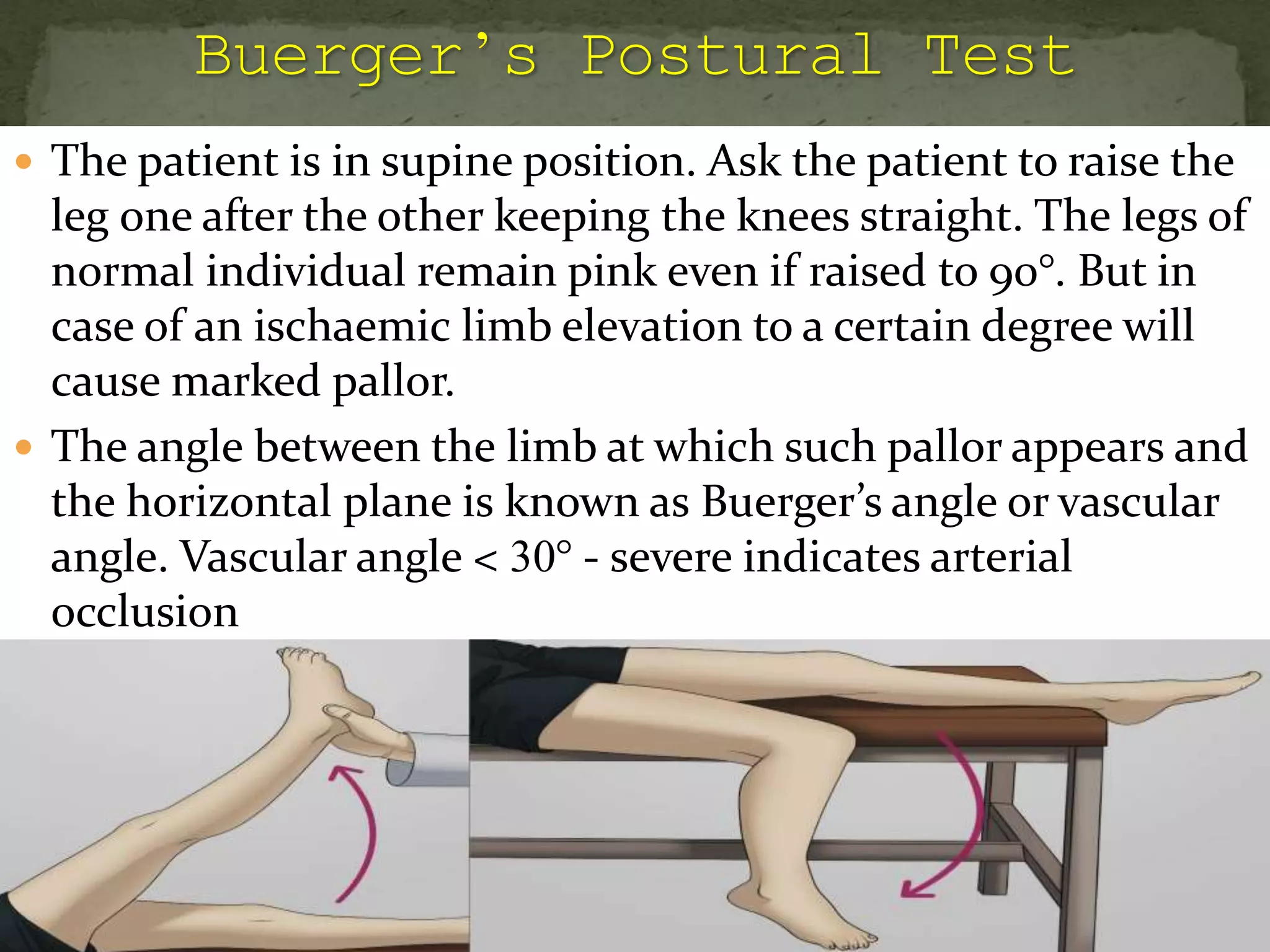  The patient is in supine position. Ask the patient to raise the
leg one after the other keeping the knees straight. The legs of
normal individual remain pink even if raised to 90°. But in
case of an ischaemic limb elevation to a certain degree will
cause marked pallor.
 The angle between the limb at which such pallor appears and
the horizontal plane is known as Buerger’s angle or vascular
angle. Vascular angle < 30° - severe indicates arterial
occlusion
 