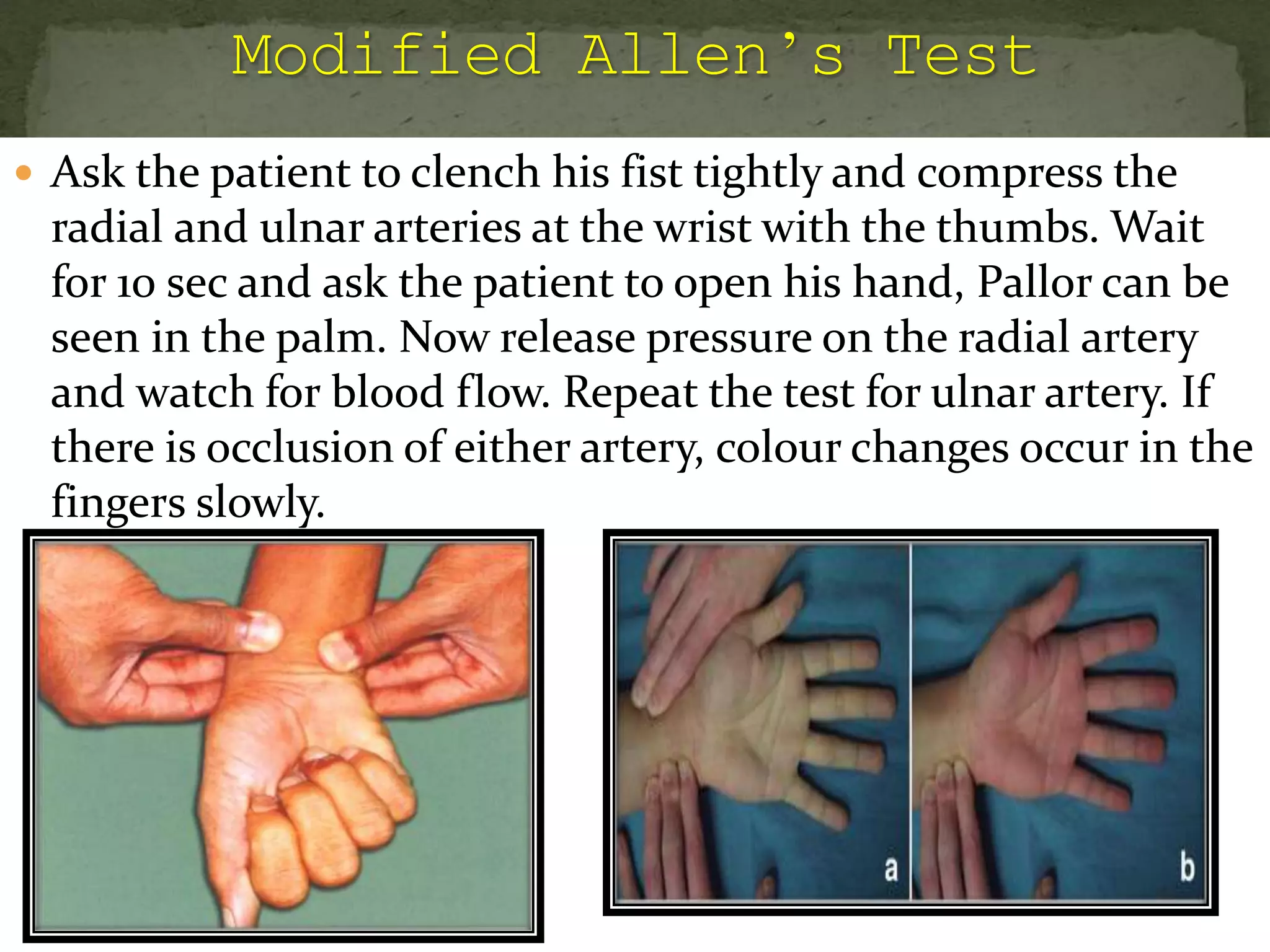  Ask the patient to clench his fist tightly and compress the
radial and ulnar arteries at the wrist with the thumbs. Wait
for 10 sec and ask the patient to open his hand, Pallor can be
seen in the palm. Now release pressure on the radial artery
and watch for blood flow. Repeat the test for ulnar artery. If
there is occlusion of either artery, colour changes occur in the
fingers slowly.
 