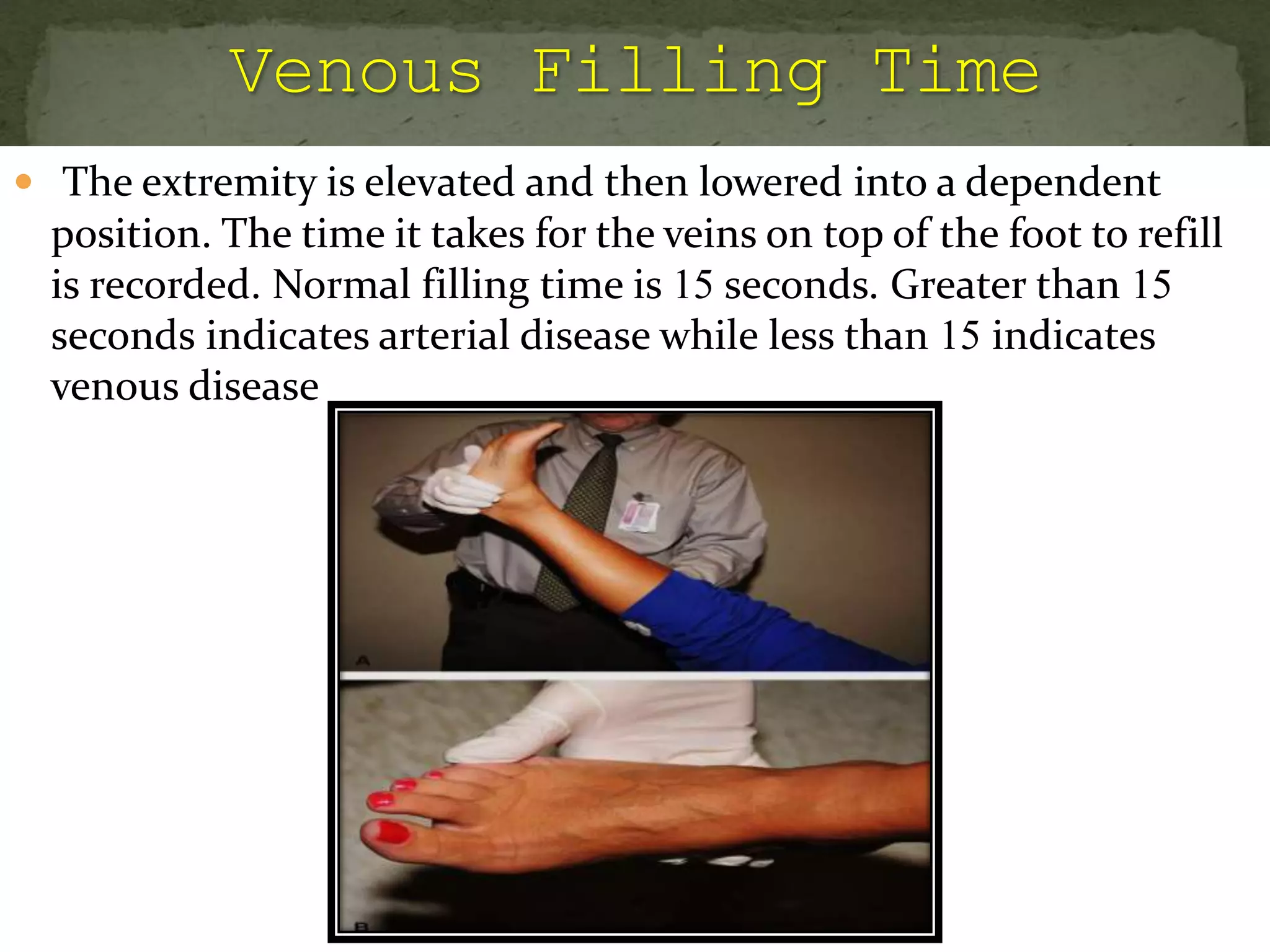  The extremity is elevated and then lowered into a dependent
position. The time it takes for the veins on top of the foot to refill
is recorded. Normal filling time is 15 seconds. Greater than 15
seconds indicates arterial disease while less than 15 indicates
venous disease
 