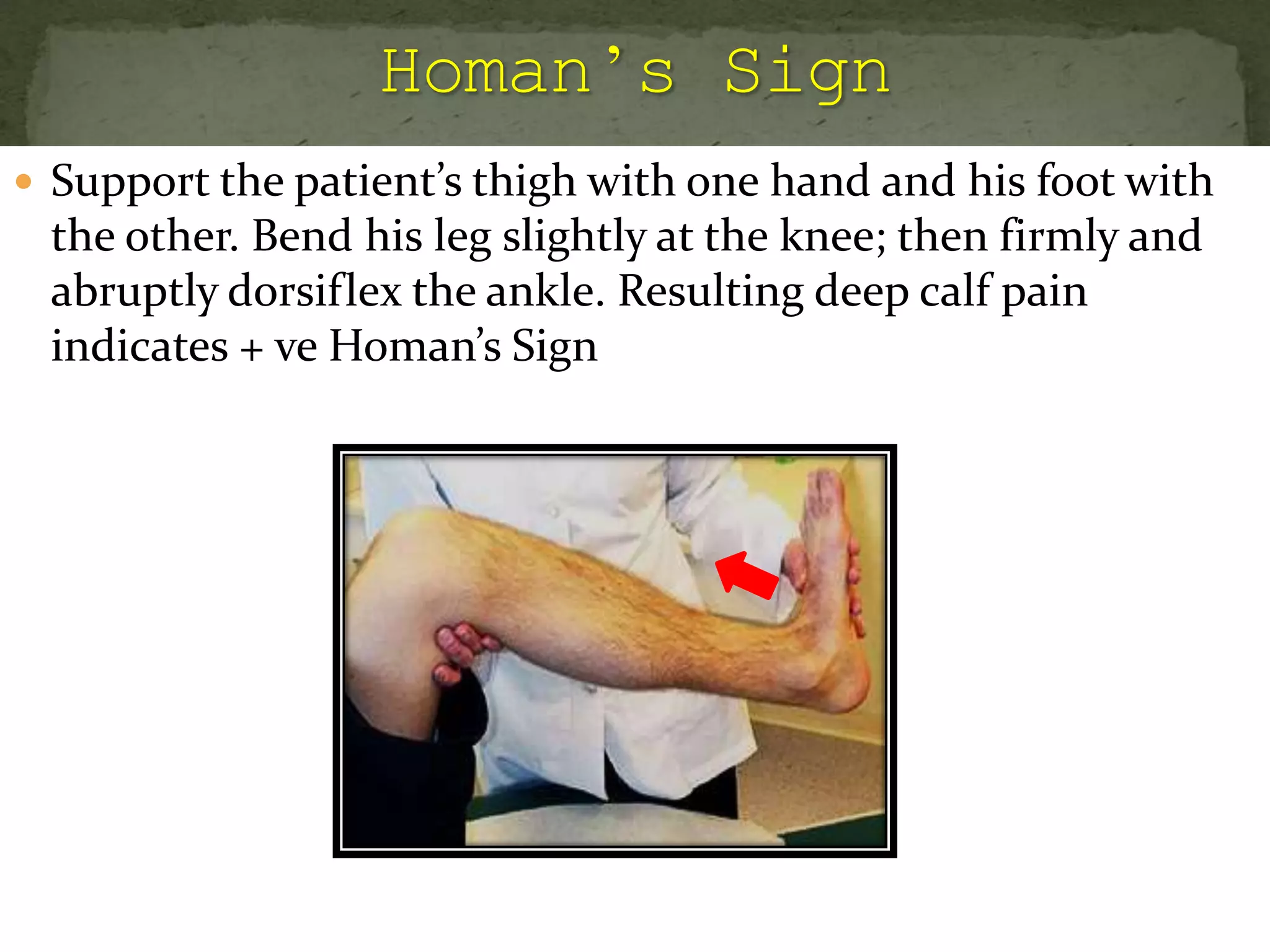  Support the patient’s thigh with one hand and his foot with
the other. Bend his leg slightly at the knee; then firmly and
abruptly dorsiflex the ankle. Resulting deep calf pain
indicates + ve Homan’s Sign
 