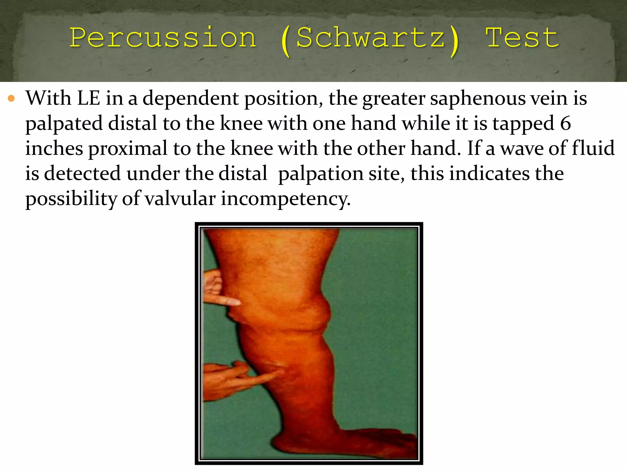  With LE in a dependent position, the greater saphenous vein is
palpated distal to the knee with one hand while it is tapped 6
inches proximal to the knee with the other hand. If a wave of fluid
is detected under the distal palpation site, this indicates the
possibility of valvular incompetency.
 