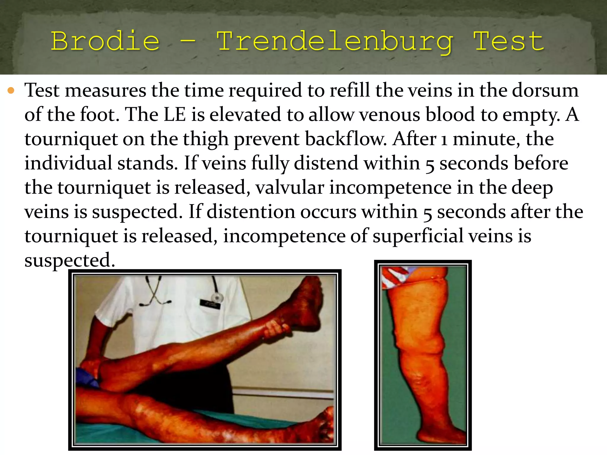  Test measures the time required to refill the veins in the dorsum
of the foot. The LE is elevated to allow venous blood to empty. A
tourniquet on the thigh prevent backflow. After 1 minute, the
individual stands. If veins fully distend within 5 seconds before
the tourniquet is released, valvular incompetence in the deep
veins is suspected. If distention occurs within 5 seconds after the
tourniquet is released, incompetence of superficial veins is
suspected.
 