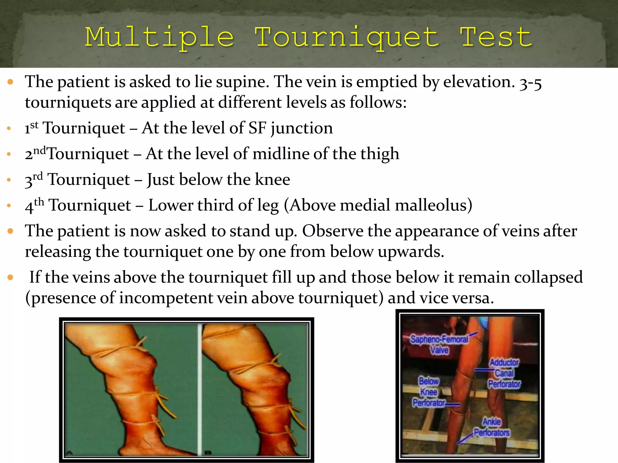  The patient is asked to lie supine. The vein is emptied by elevation. 3-5
tourniquets are applied at different levels as follows:
• 1st Tourniquet – At the level of SF junction
• 2ndTourniquet – At the level of midline of the thigh
• 3rd Tourniquet – Just below the knee
• 4th Tourniquet – Lower third of leg (Above medial malleolus)
 The patient is now asked to stand up. Observe the appearance of veins after
releasing the tourniquet one by one from below upwards.
 If the veins above the tourniquet fill up and those below it remain collapsed
(presence of incompetent vein above tourniquet) and vice versa.
 