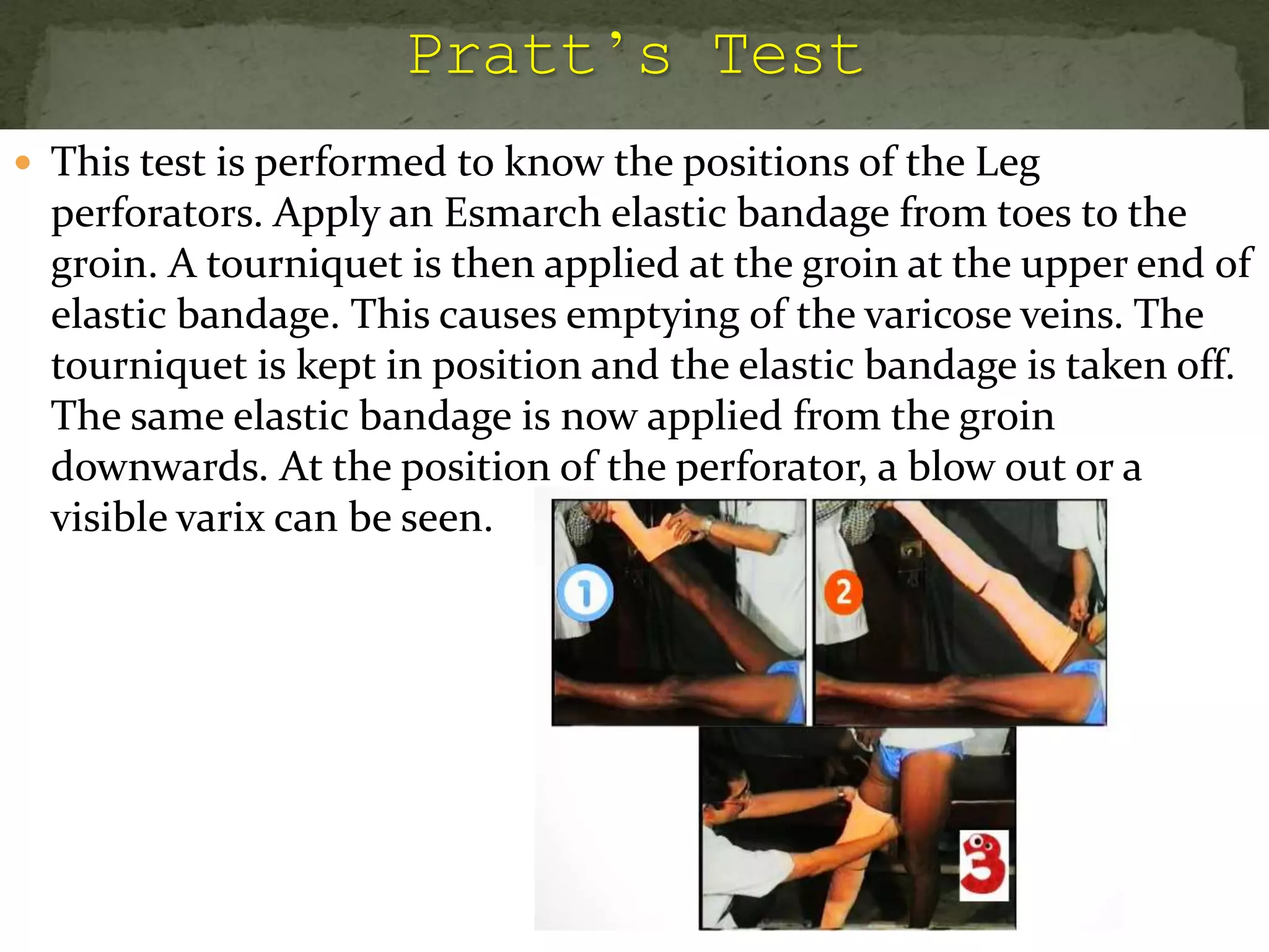  This test is performed to know the positions of the Leg
perforators. Apply an Esmarch elastic bandage from toes to the
groin. A tourniquet is then applied at the groin at the upper end of
elastic bandage. This causes emptying of the varicose veins. The
tourniquet is kept in position and the elastic bandage is taken off.
The same elastic bandage is now applied from the groin
downwards. At the position of the perforator, a blow out or a
visible varix can be seen.
 