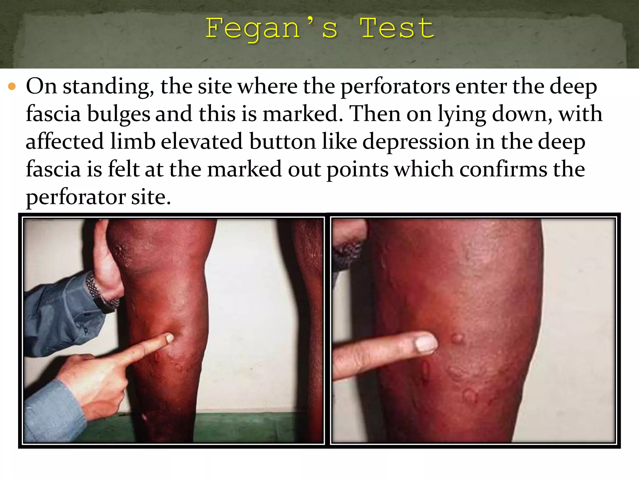  On standing, the site where the perforators enter the deep
fascia bulges and this is marked. Then on lying down, with
affected limb elevated button like depression in the deep
fascia is felt at the marked out points which confirms the
perforator site.
 