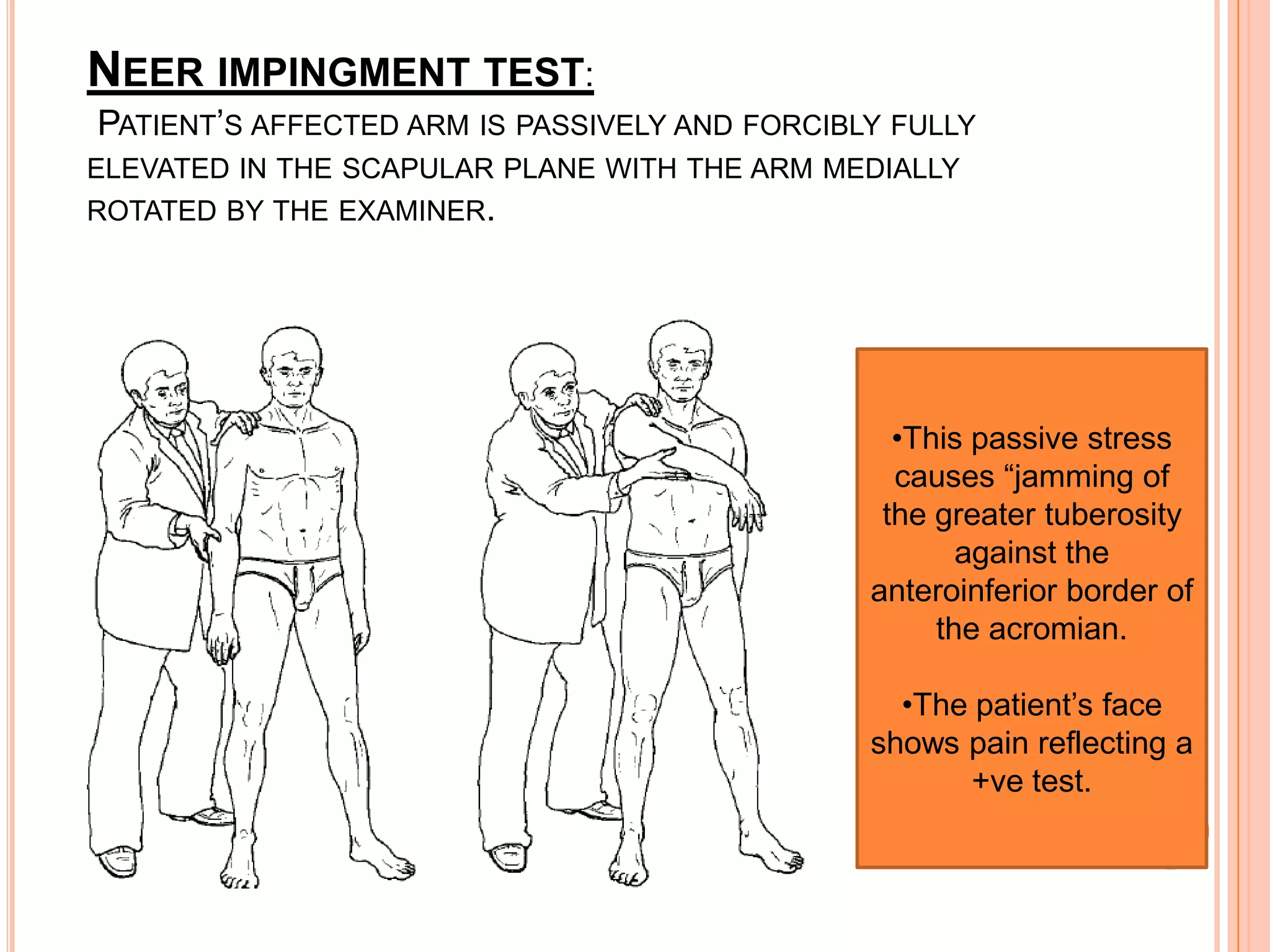 NEER IMPINGMENT TEST:
PATIENT’S AFFECTED ARM IS PASSIVELY AND FORCIBLY FULLY
ELEVATED IN THE SCAPULAR PLANE WITH THE ARM MEDIALLY
ROTATED BY THE EXAMINER.




                                                 •This passive stress
                                                 causes “jamming of
                                                the greater tuberosity
                                                      against the
                                               anteroinferior border of
                                                    the acromian.

                                                 •The patient’s face
                                               shows pain reflecting a
                                                     +ve test.
 