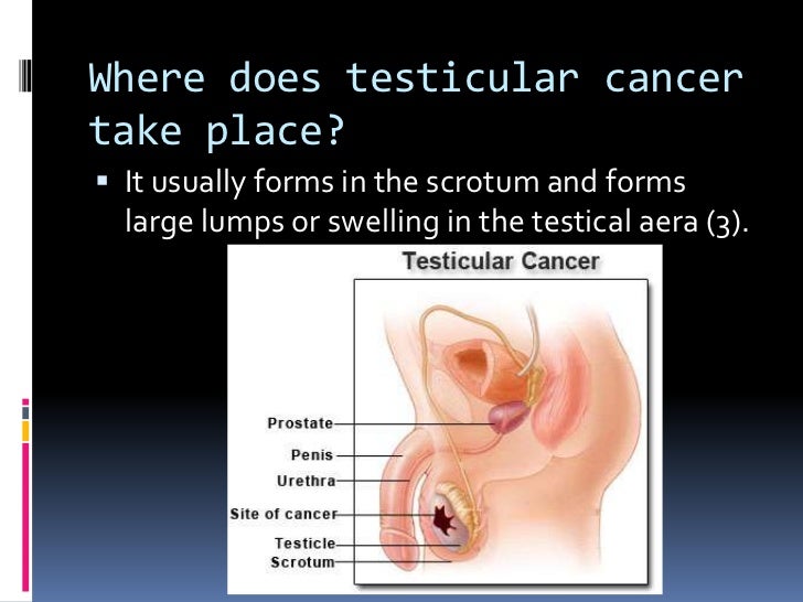 testicular cancer 3 728 jpg cb 1330287732 how do cancer form