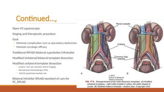 Open Rplnd The surgical and medical management of testicular tumors.pptx
