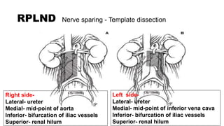 Left Template Rplnd testicular carcinoma - Dr ravi.pptx