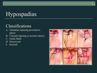 Hypospadias
Classifications
A. Glandular (opening proximal to
   glans)
B. Coronal (opening at coronal sulcus)
C. Penile Shaft
D. Penoscrotal
F. Perineal
 