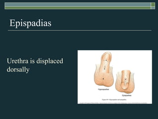 Epispadias


Urethra is displaced
dorsally
 