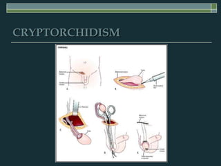 CRYPTORCHIDISM
 