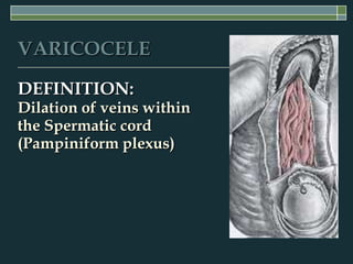 VARICOCELE

DEFINITION:
Dilation of veins within
the Spermatic cord
(Pampiniform plexus)
 