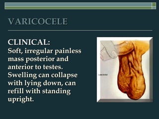VARICOCELE

CLINICAL:
Soft, irregular painless
mass posterior and
anterior to testes.
Swelling can collapse
with lying down, can
refill with standing
upright.
 