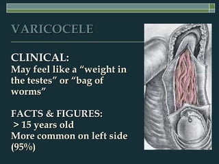 VARICOCELE

CLINICAL:
May feel like a “weight in
the testes” or “bag of
worms”

FACTS & FIGURES:
 > 15 years old
More common on left side
(95%)
 