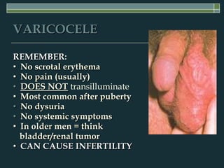 VARICOCELE

REMEMBER:
• No scrotal erythema
• No pain (usually)
• DOES NOT transilluminate
• Most common after puberty
• No dysuria
• No systemic symptoms
• In older men = think
  bladder/renal tumor
• CAN CAUSE INFERTILITY
 