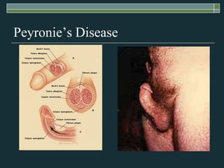 Peyronie’s Disease
 