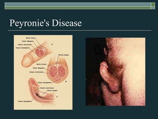 Peyronie's Disease
 