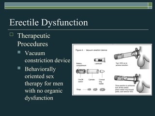 Erectile Dysfunction
   Therapeutic
    Procedures
       Vacuum
        constriction device
       Behaviorally
        oriented sex
        therapy for men
        with no organic
        dysfunction
 
