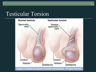 Testicular Torsion
 