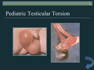 Pediatric Testicular Torsion
 