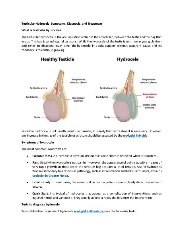 Testicular hydrocele symptoms, diagnosis, and treatment