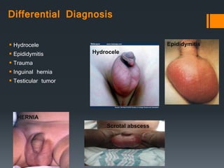 Differential Diagnosis
 Hydrocele
 Epididymitis
 Trauma
 Inguinal hernia
 Testicular tumor
Hydrocele
Epididymitis
HERNIA
Scrotal abscess
 