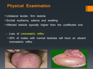 Physical Examination
Unilateral tender, firm testicle
Scrotal erythema, edema and swelling
Affected testicle typically higher than the unaffected one.
- Loss of cremasteric reflex
30% of males with normal testicles will have an absent
cremasteric reflex
 