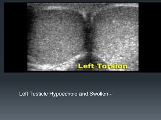 Left Testicle Hypoechoic and Swollen -
 