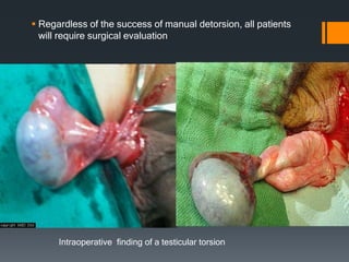  Regardless of the success of manual detorsion, all patients
will require surgical evaluation
Intraoperative finding of a testicular torsion
 