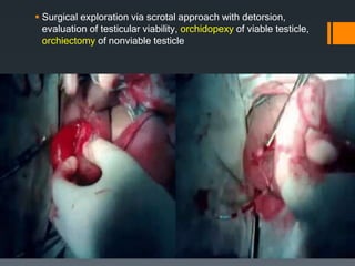  Surgical exploration via scrotal approach with detorsion,
evaluation of testicular viability, orchidopexy of viable testicle,
orchiectomy of nonviable testicle
 