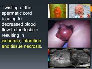 Twisting of the
spermatic cord
leading to
decreased blood
flow to the testicle
resulting in
ischemia, infarction
and tissue necrosis.
NO FLOW
 