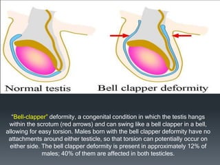 “Bell-clapper” deformity, a congenital condition in which the testis hangs
within the scrotum (red arrows) and can swing like a bell clapper in a bell,
allowing for easy torsion. Males born with the bell clapper deformity have no
attachments around either testicle, so that torsion can potentially occur on
either side. The bell clapper deformity is present in approximately 12% of
males; 40% of them are affected in both testicles.
 