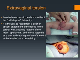 Extravaginal torsion
 Most often occurs in newborns without
the “bell clapper” deformity.
 It is thought to result from a poor or
absent attachment of the testis to the
scrotal wall, allowing rotation of the
testis, epididymis, and tunica vaginalis
as a unit and causing torsion of the cord
at the level of the external ring
 