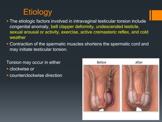 Etiology
 The etiologic factors involved in intravaginal testicular torsion include
congenital anomaly, bell clapper deformity, undescended testicle,
sexual arousal or activity, exercise, active cremasteric reflex, and cold
weather
 Contraction of the spermatic muscles shortens the spermatic cord and
may initiate testicular torsion.
Torsion may occur in either
 clockwise or
 counterclockwise direction
 