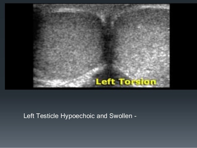 Cpt Code For Manual Detorsion Of Testicle Cpt Code For Manual Detorsion Of Testicle